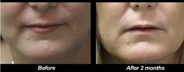 Levantamiento de papadas sin cirugia