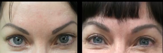 transplante de cejas